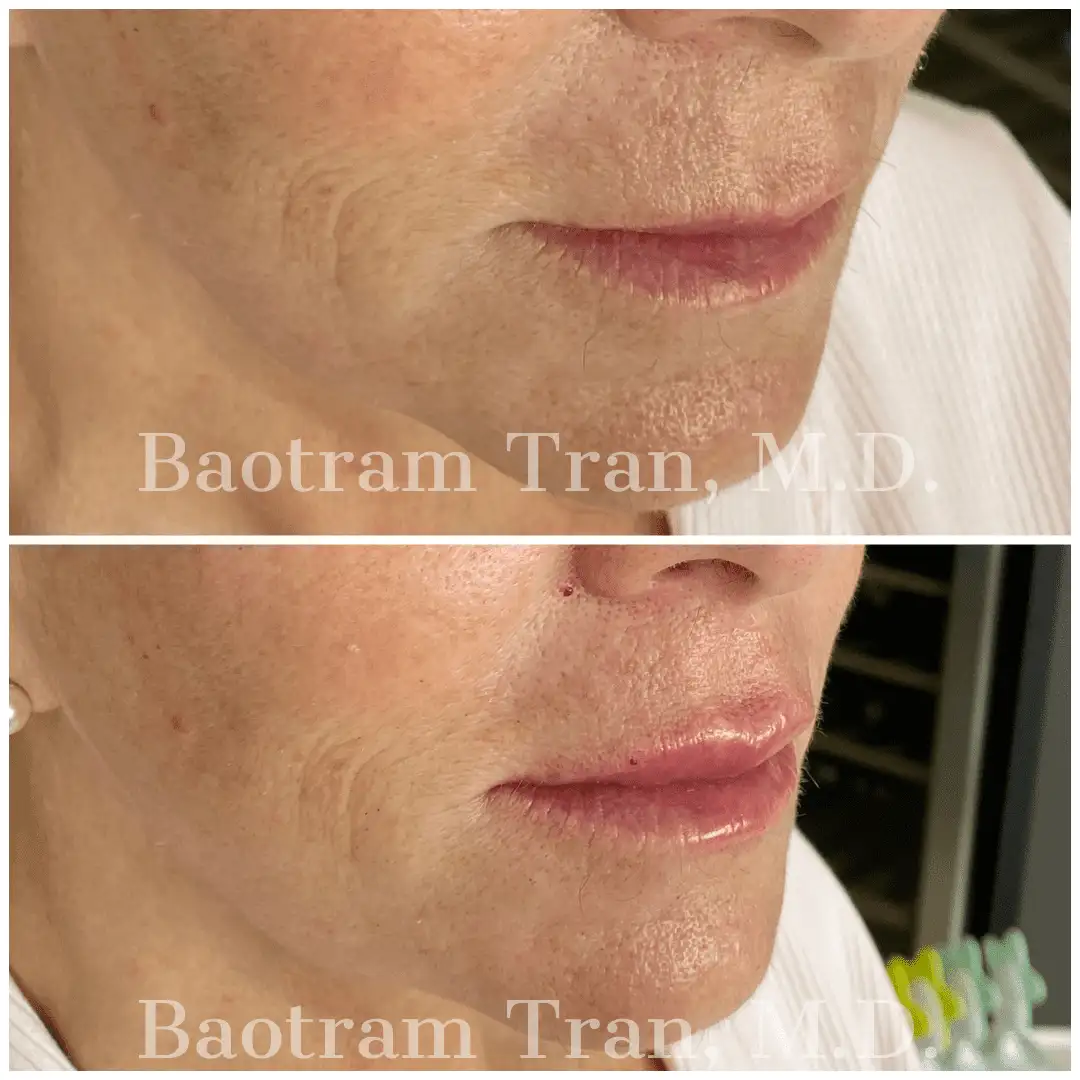 Before and After Image: Non-Surgical Procedure - 