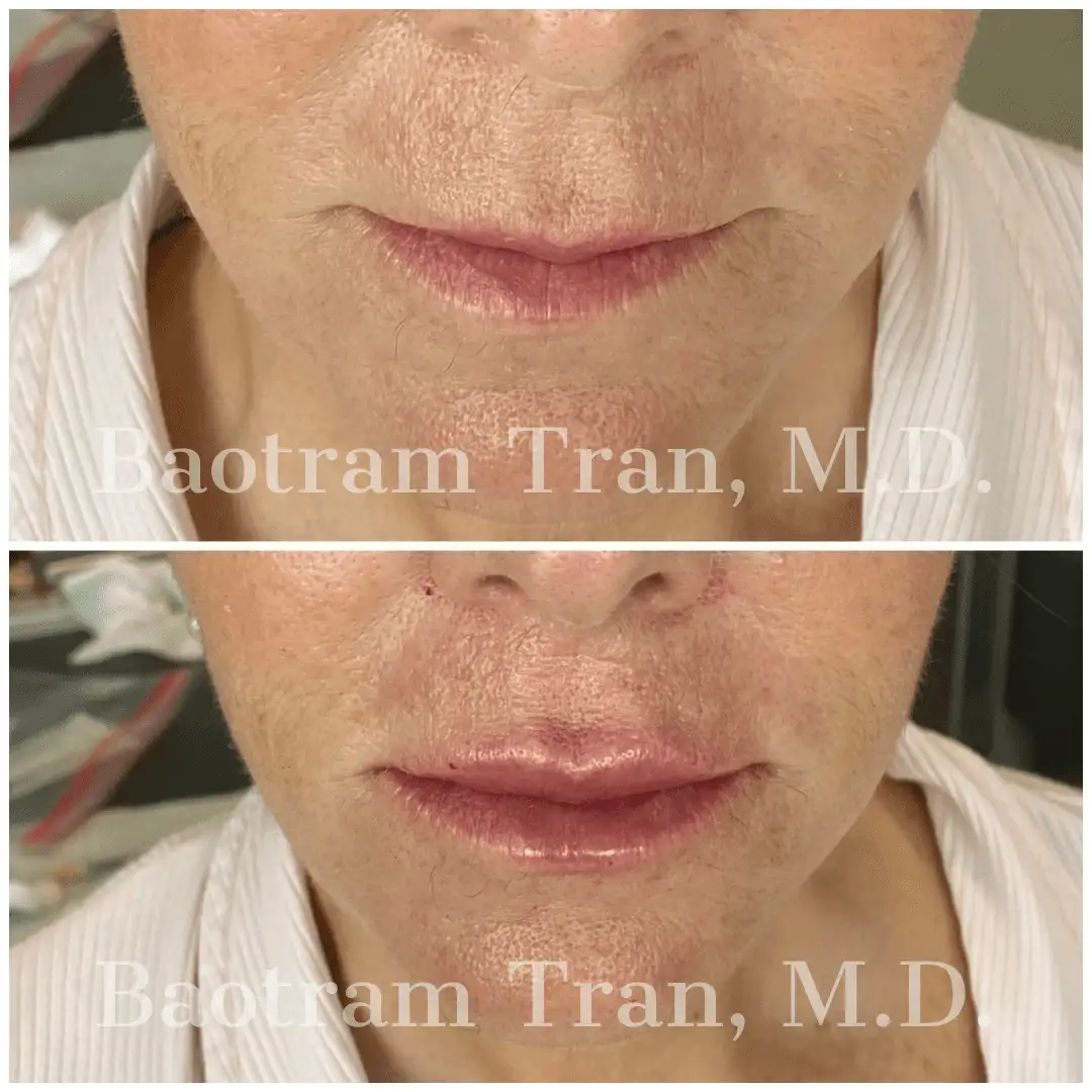 Before and After Image: Non-Surgical Procedure - front