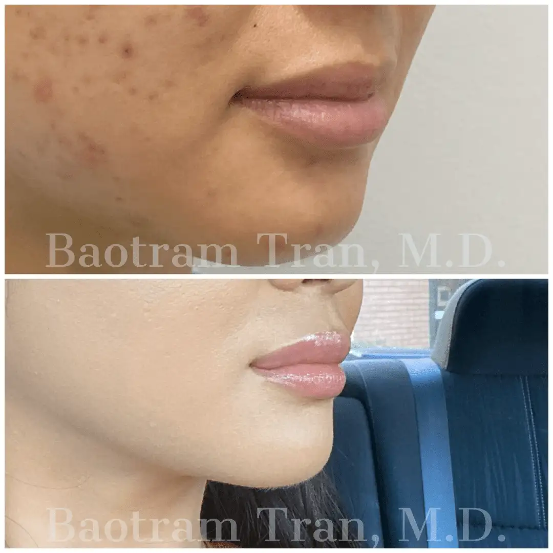Before and After Image: Non-Surgical Procedure - 