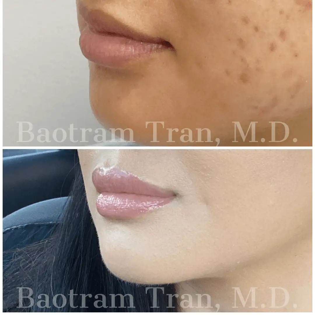Before and After Image: Non-Surgical Procedure - 