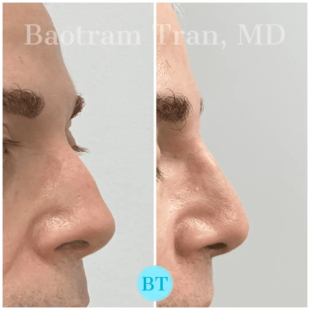 Before and After Image: Non-Surgical Procedure - front