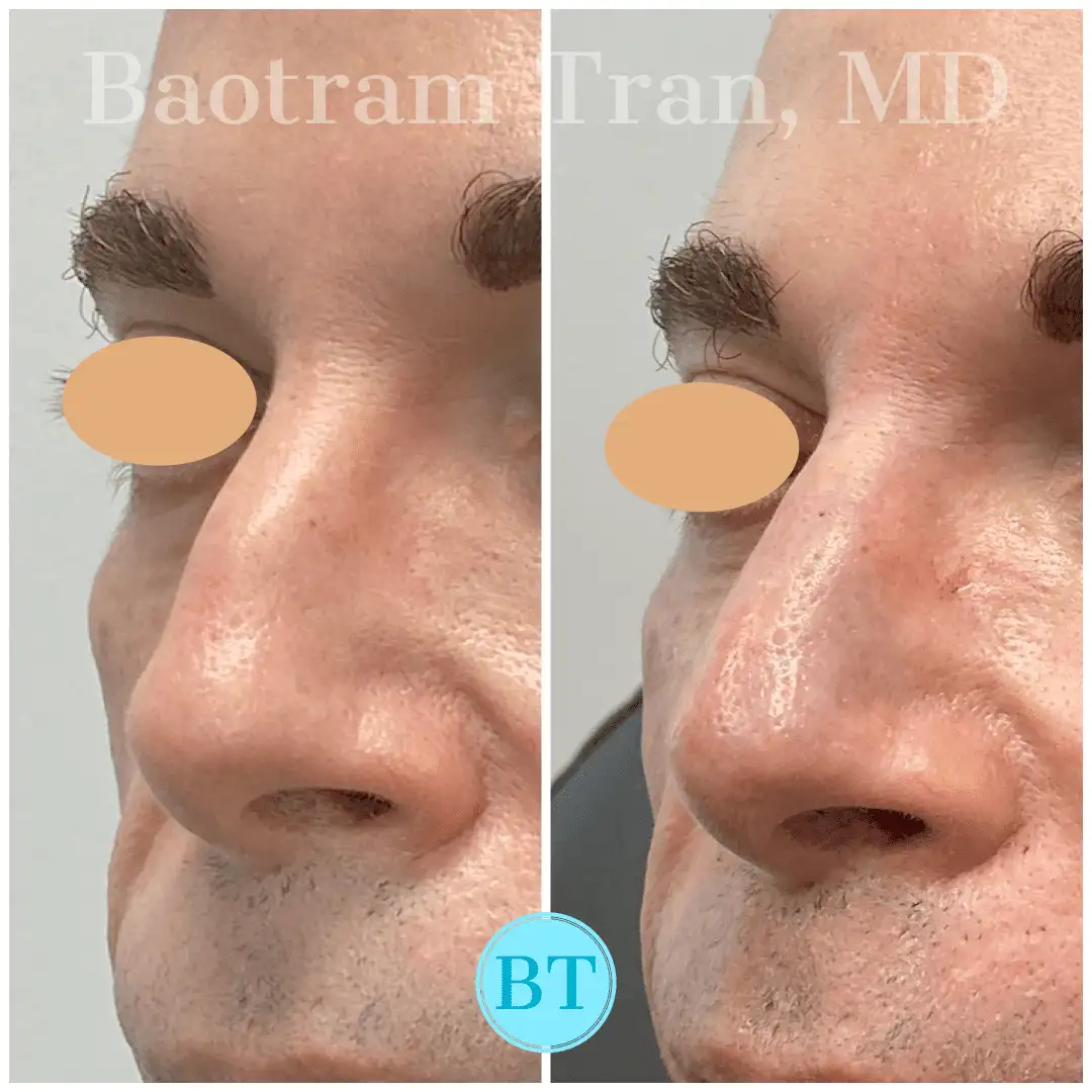 Before and After Image: Non-Surgical Procedure - front
