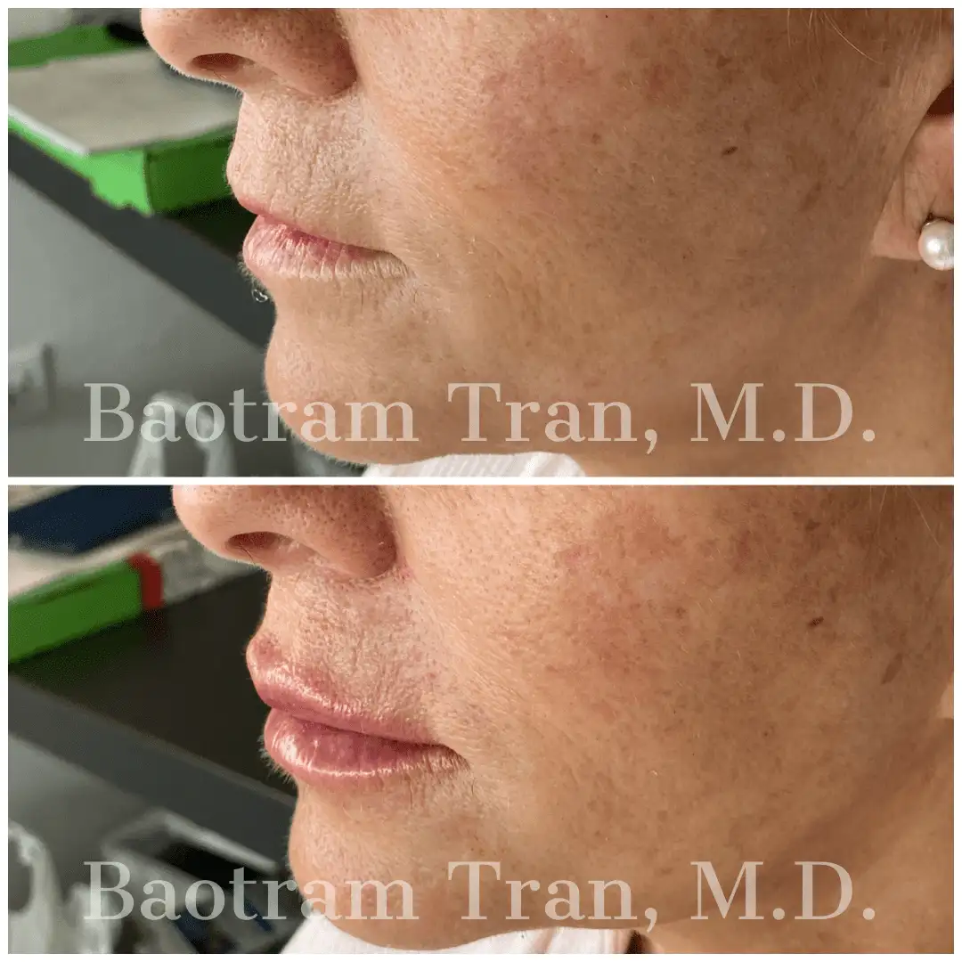 Before and After Image: Non-Surgical Procedure - 