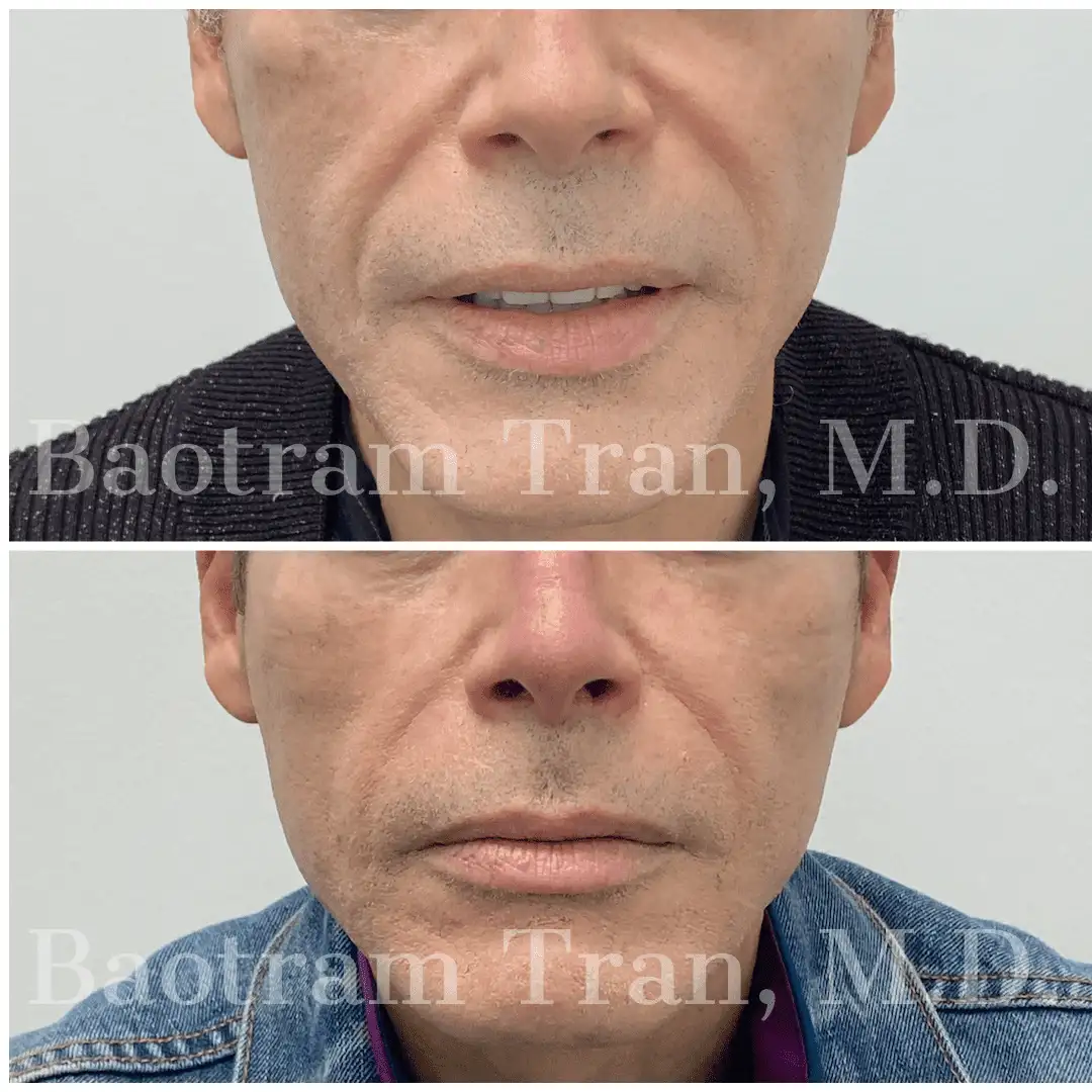 Before and After Image: Non-Surgical Procedure - front