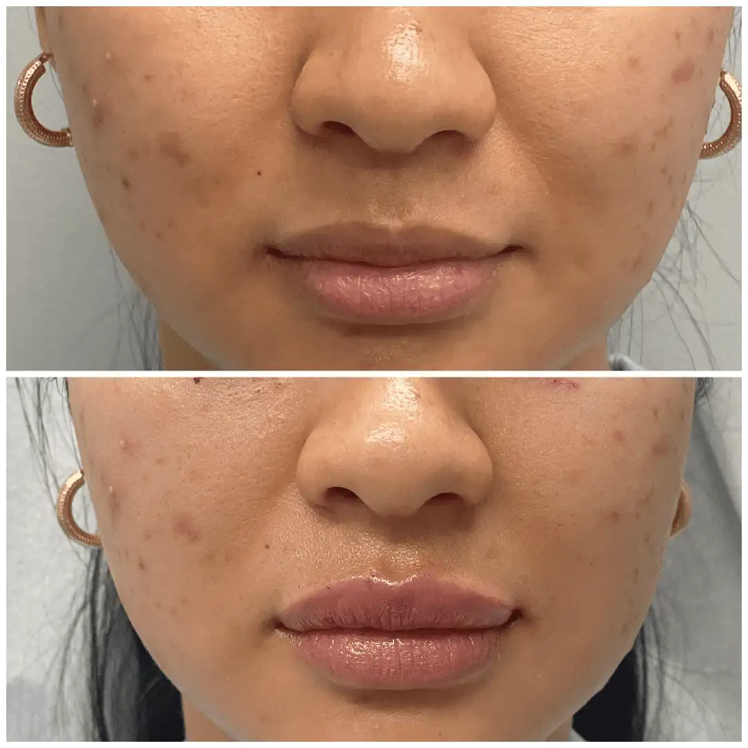 Before and After Image: Non-Surgical Procedure - front
