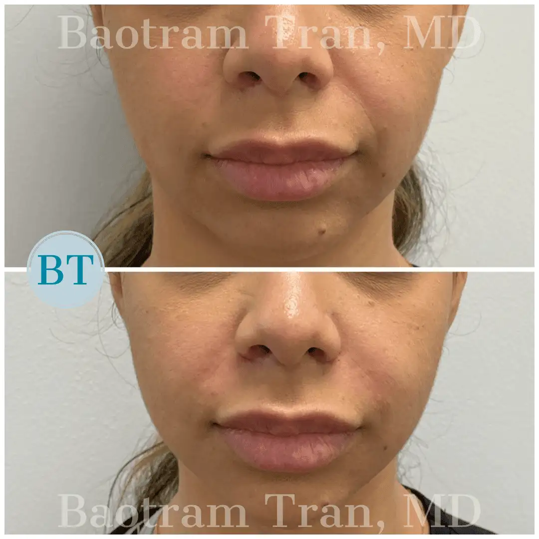 Before and After Image: Non-Surgical Procedure - front
