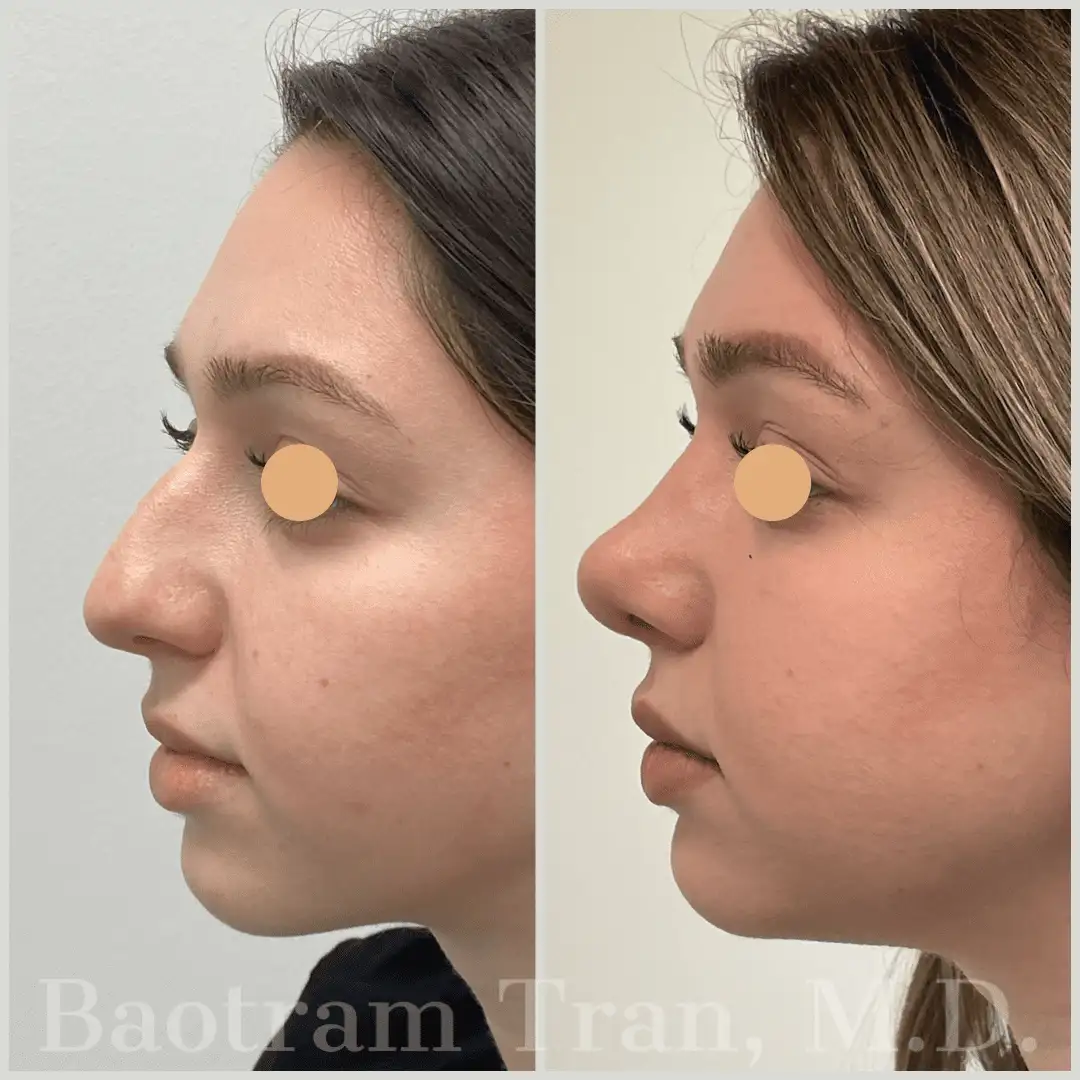 Before and After Image: Rhinoplasty - left-side
