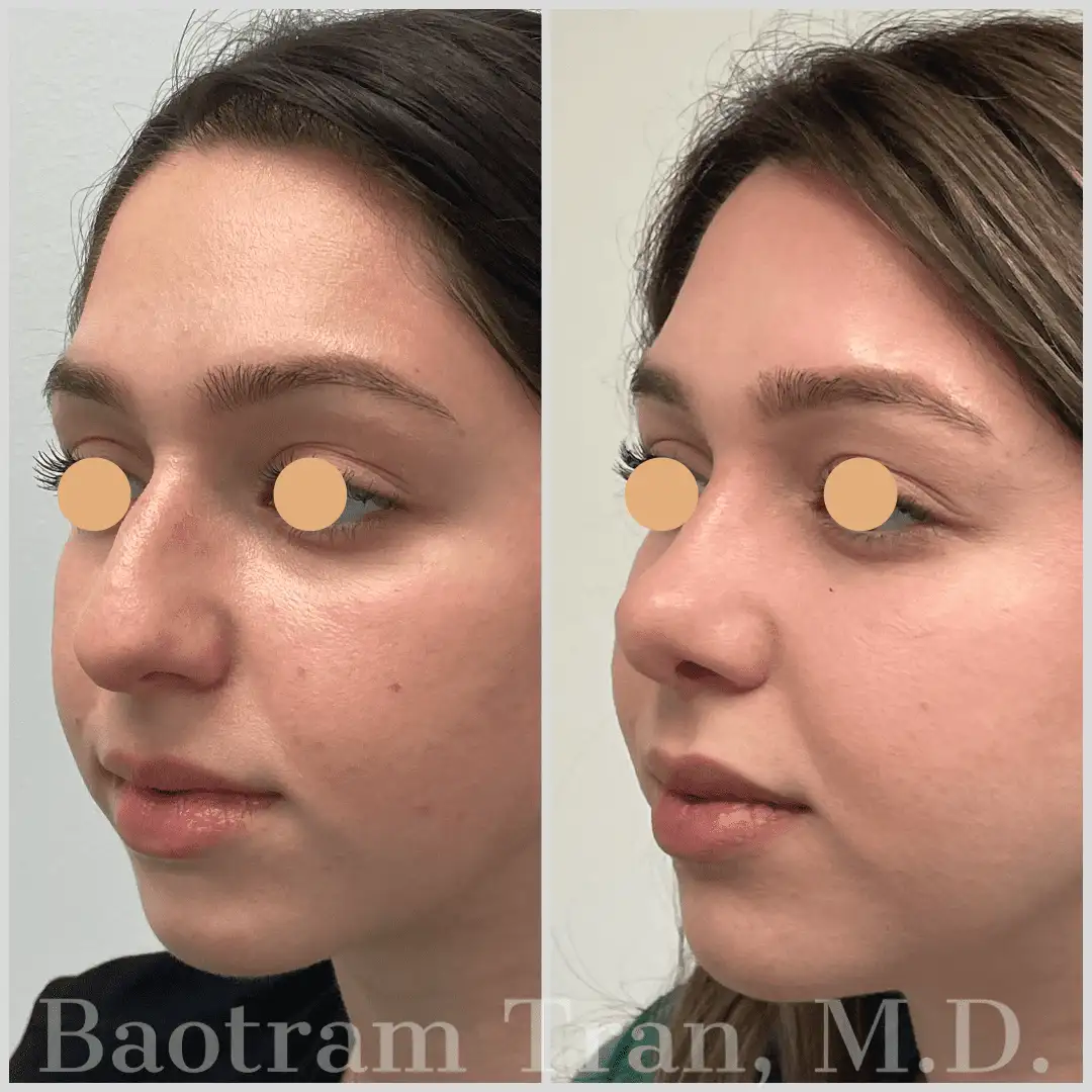 Before and After Image: Rhinoplasty - left-front-oblique
