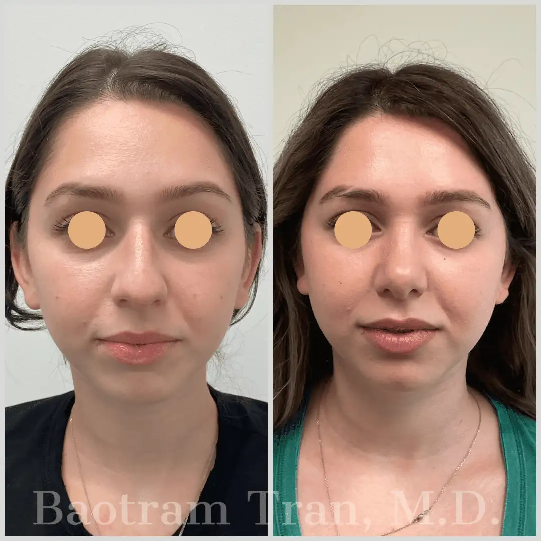 Before and After Image: Rhinoplasty - front