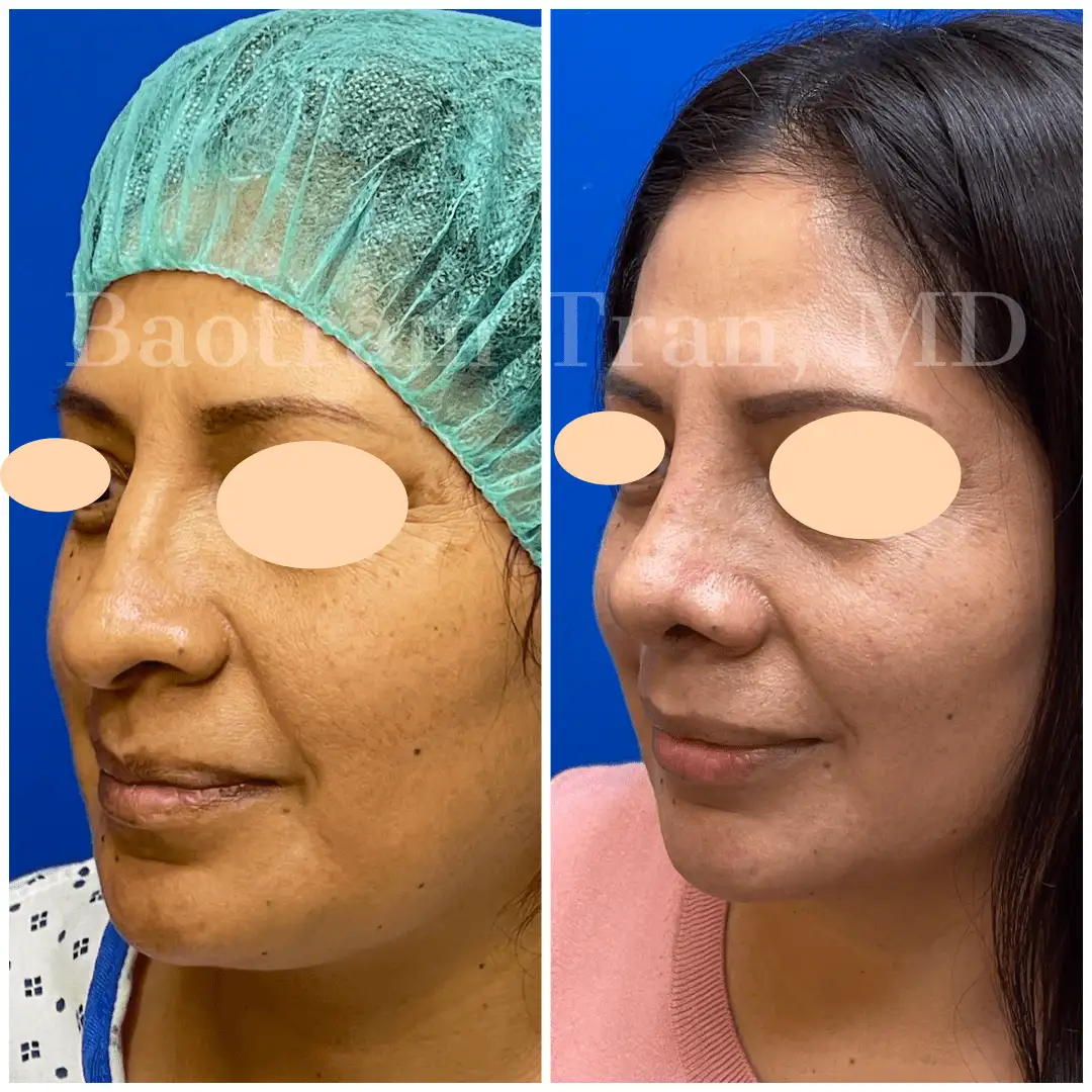 Before and After Image: Rhinoplasty