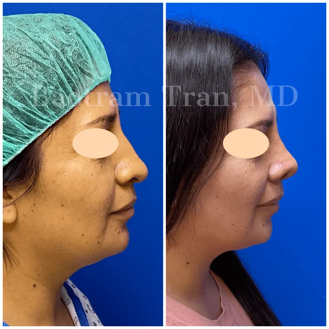 Before and After Image: Rhinoplasty - right-side
