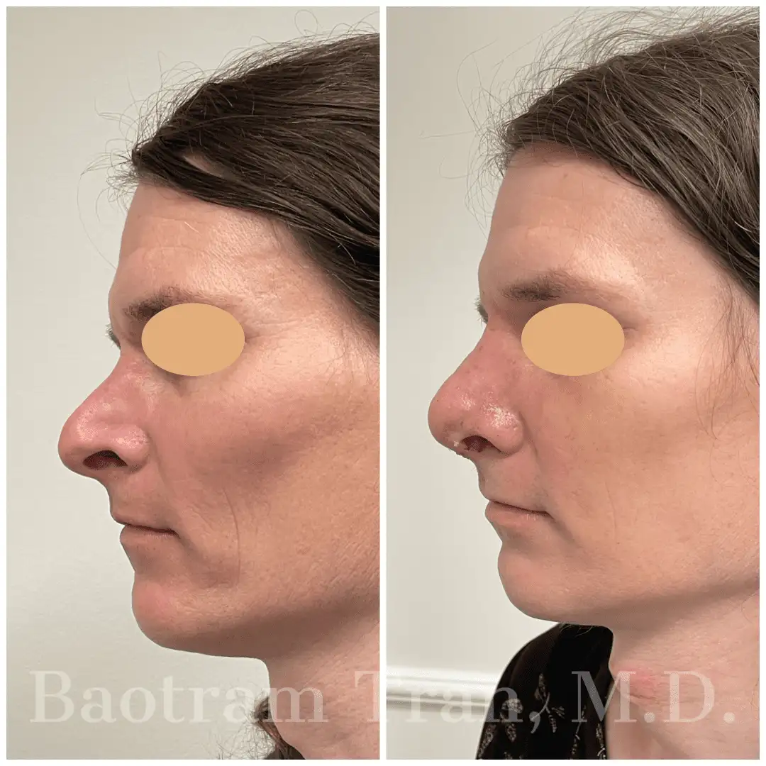 Before and After Image: Rhinoplasty