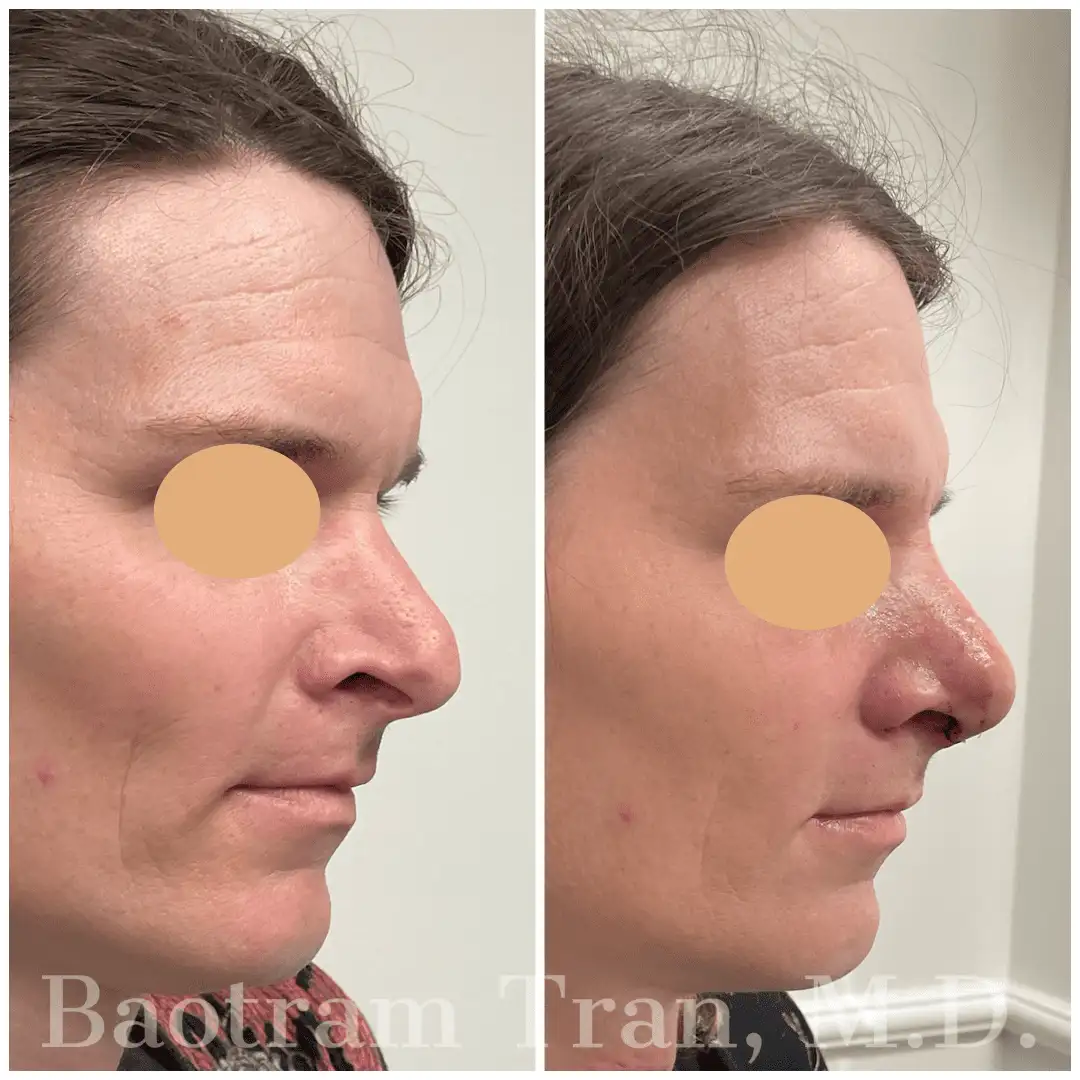 Before and After Image: Rhinoplasty - right-side