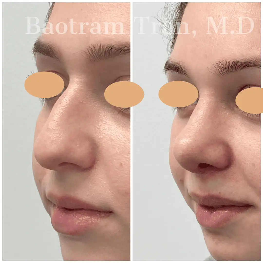 Before and After Image: Rhinoplasty - left-front-oblique