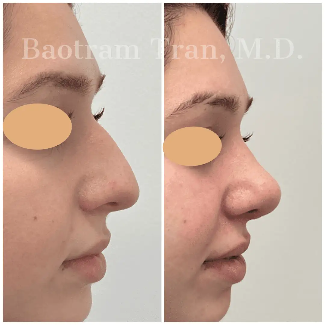 Before and After Image: Rhinoplasty - right-side