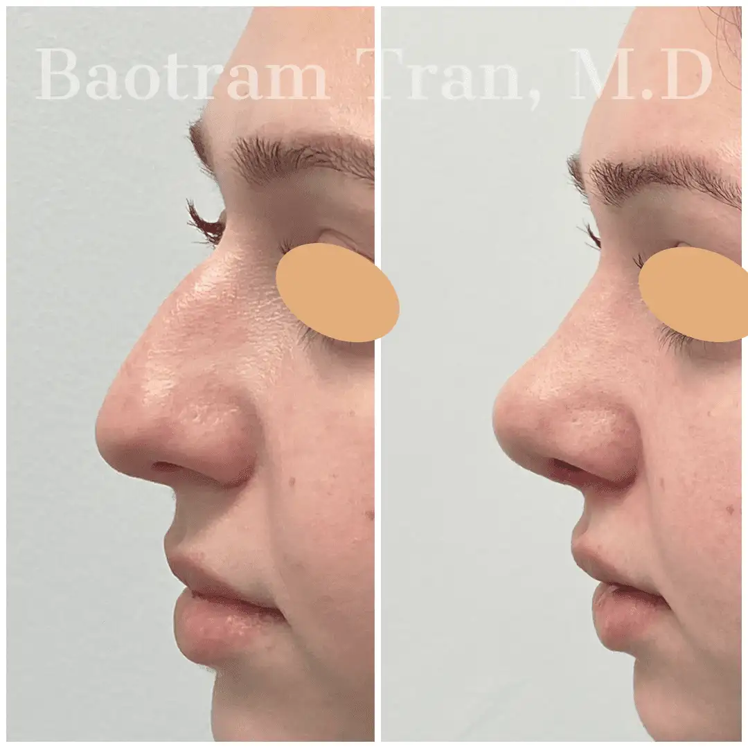 Before and After Image: Rhinoplasty - left-side