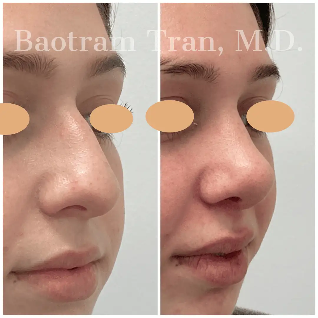 Before and After Image: Rhinoplasty - front