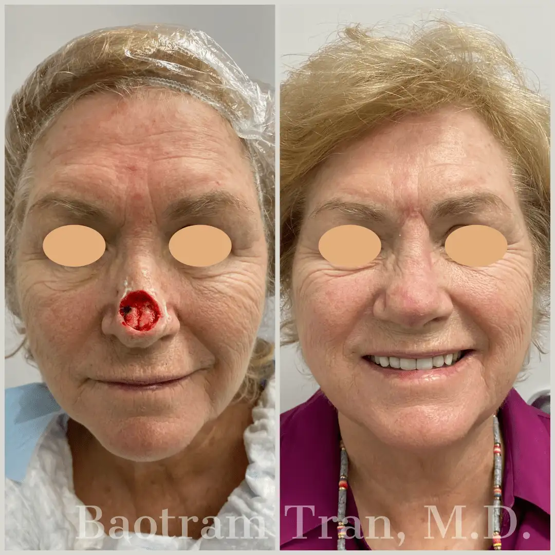 Before and After Image: Skin Cancer Excision And Reconstruction - front
