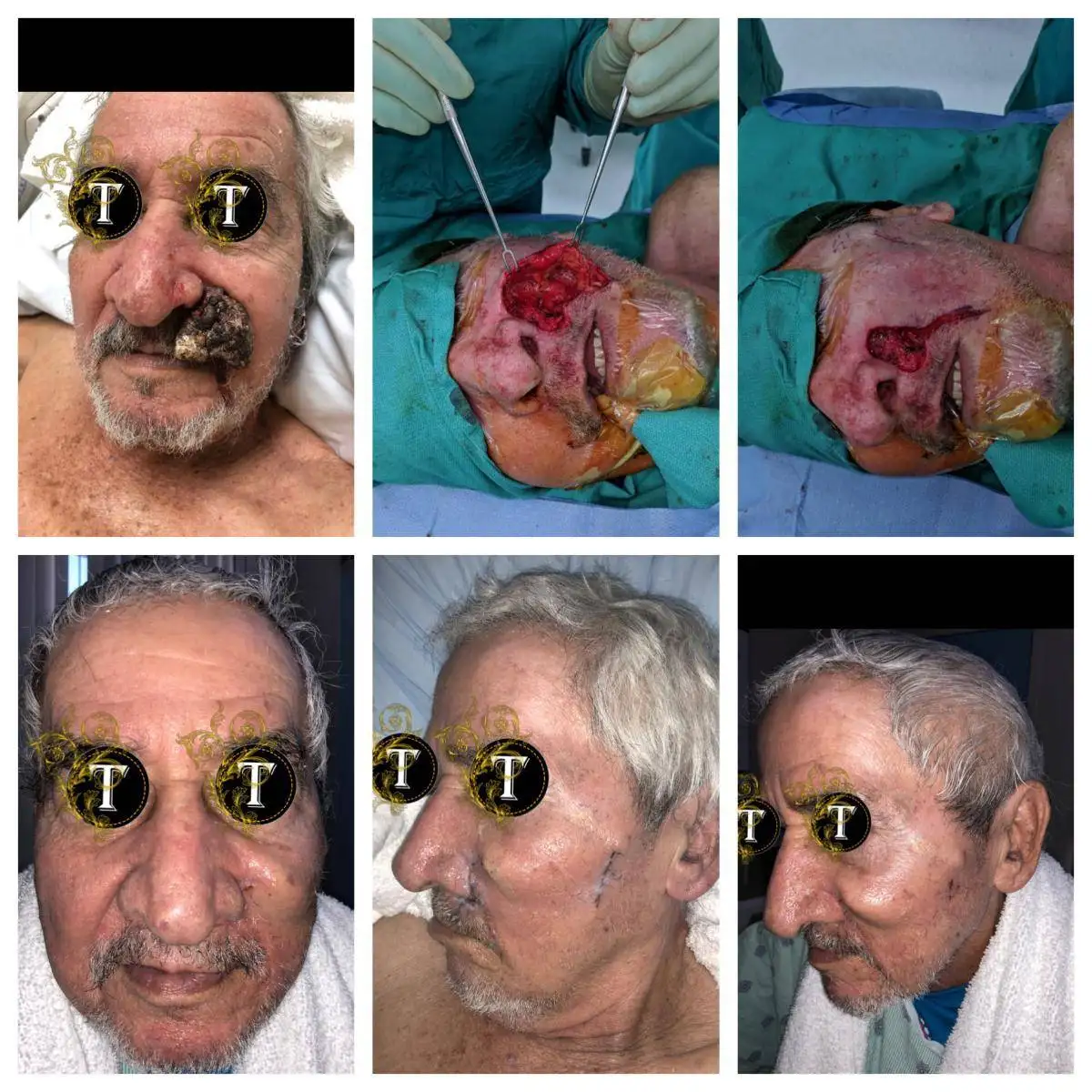 Before and After Image: Skin Cancer Excision And Reconstruction - front