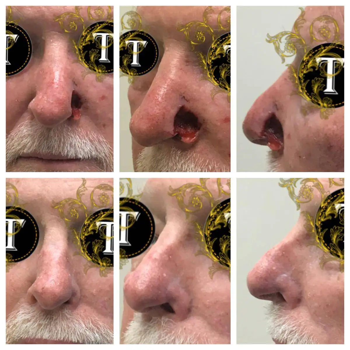 Before and After Image: Skin Cancer Excision And Reconstruction - front