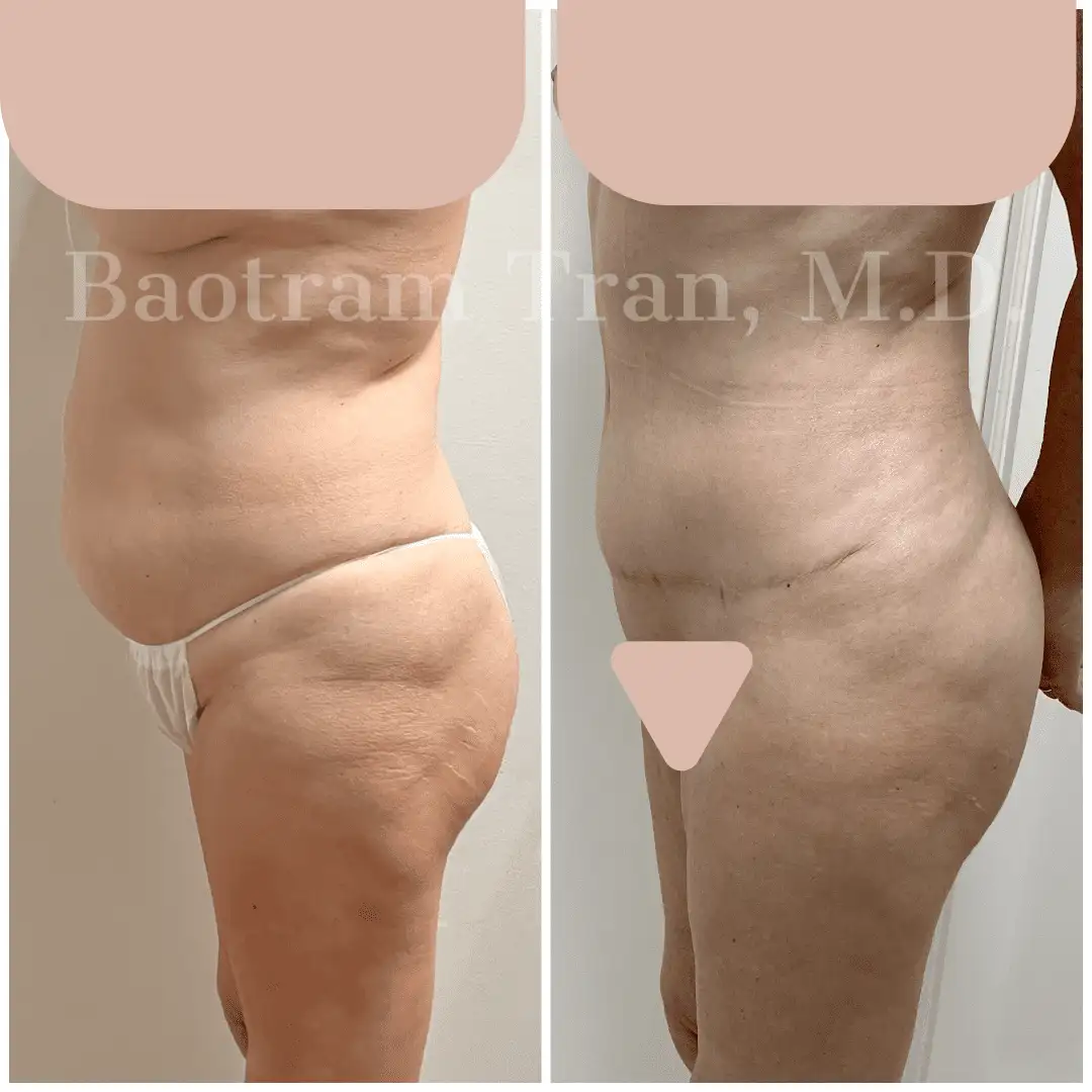 Before and After Image: Tummy Tuck - left-side