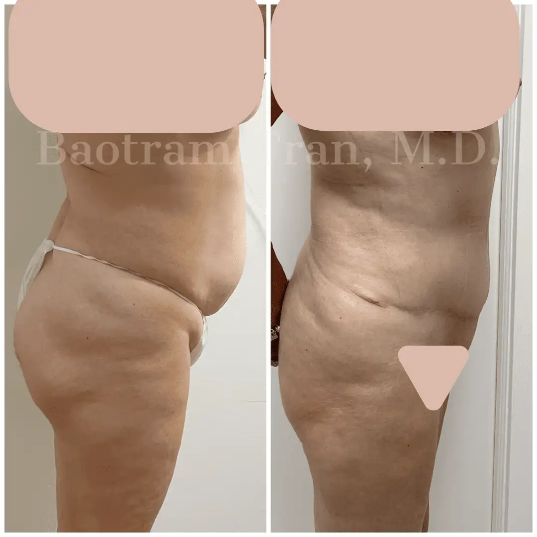 Before and After Image: Tummy Tuck - right-side