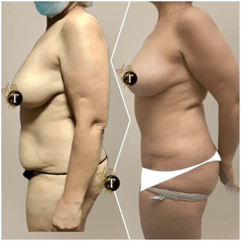 Before and After Image: Tummy Tuck - left-side