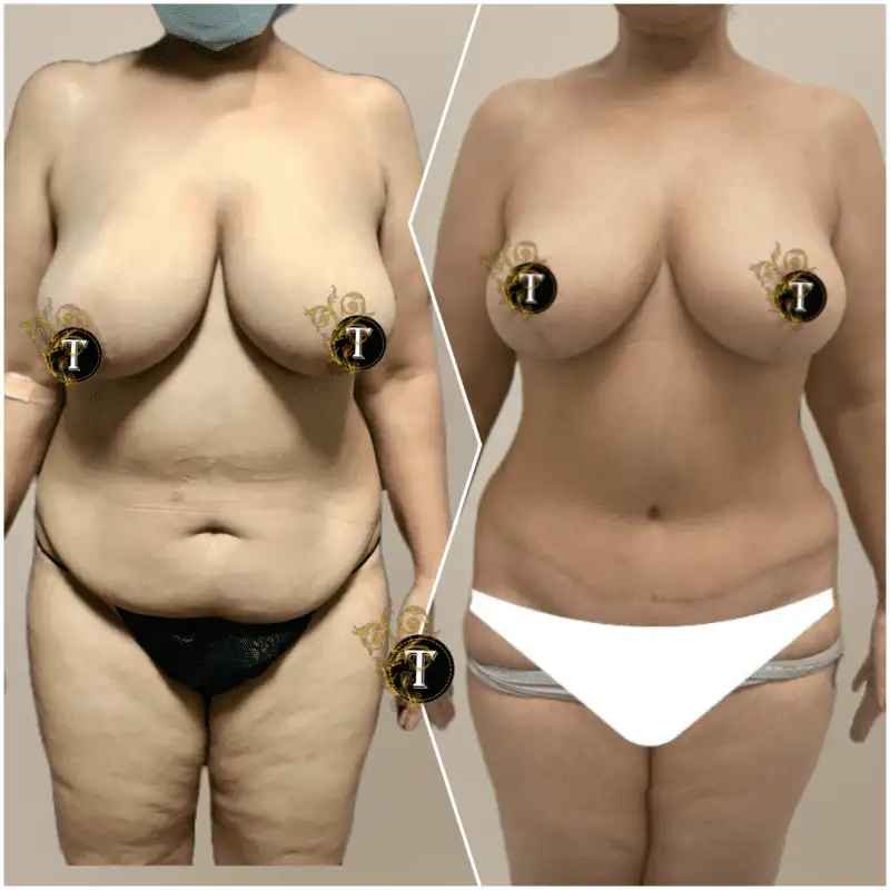 Before and After Image: Tummy Tuck - front