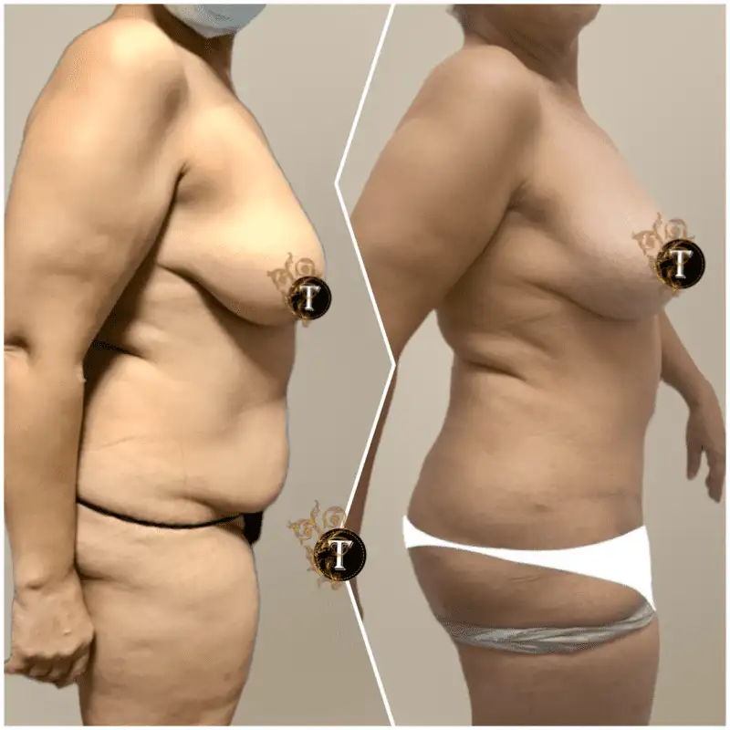 Before and After Image: Tummy Tuck - right-side