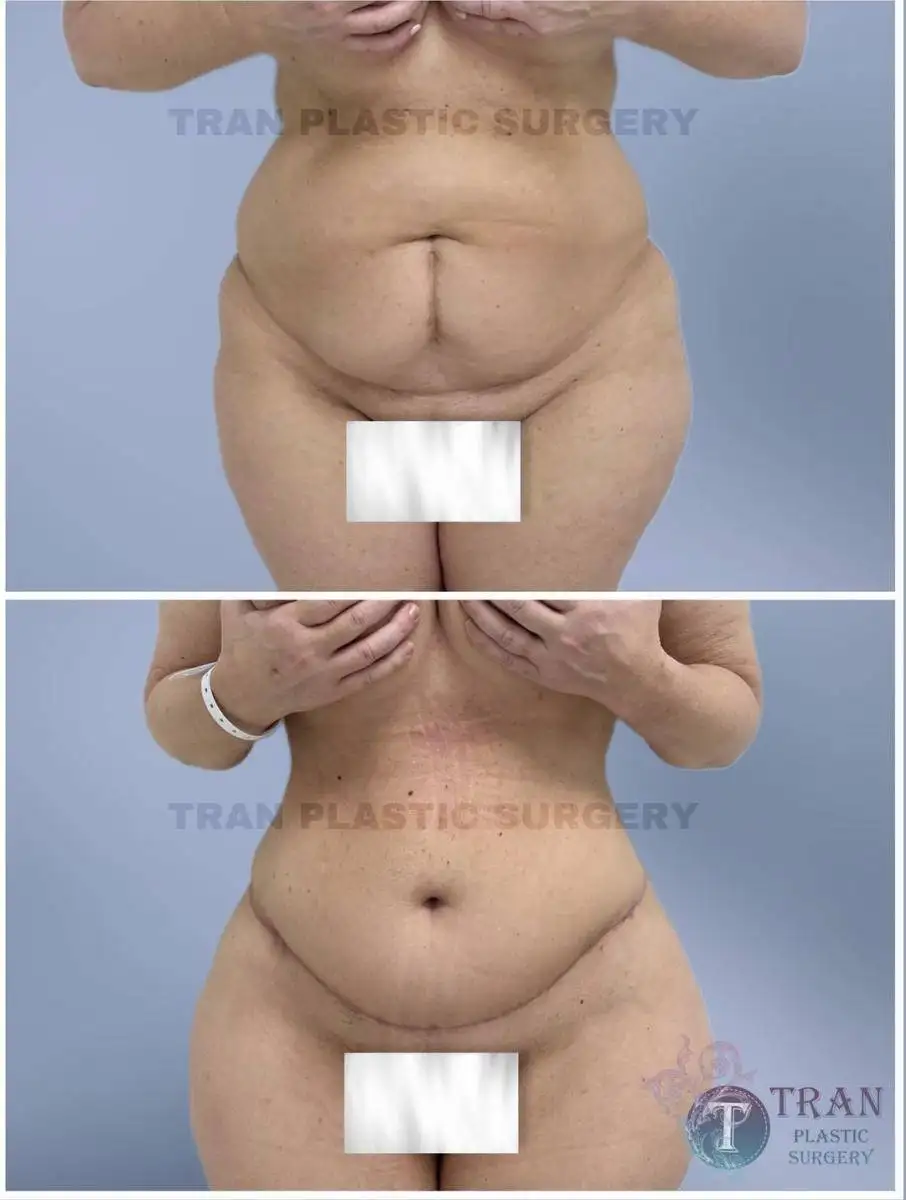 Before and After Image: Tummy Tuck - front