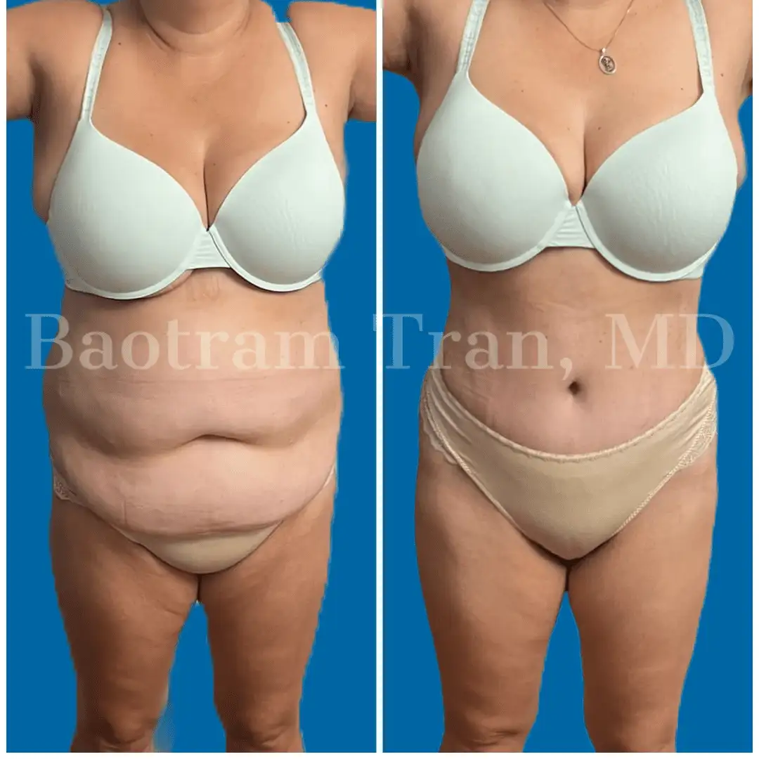 Before and After Image: Tummy Tuck - front