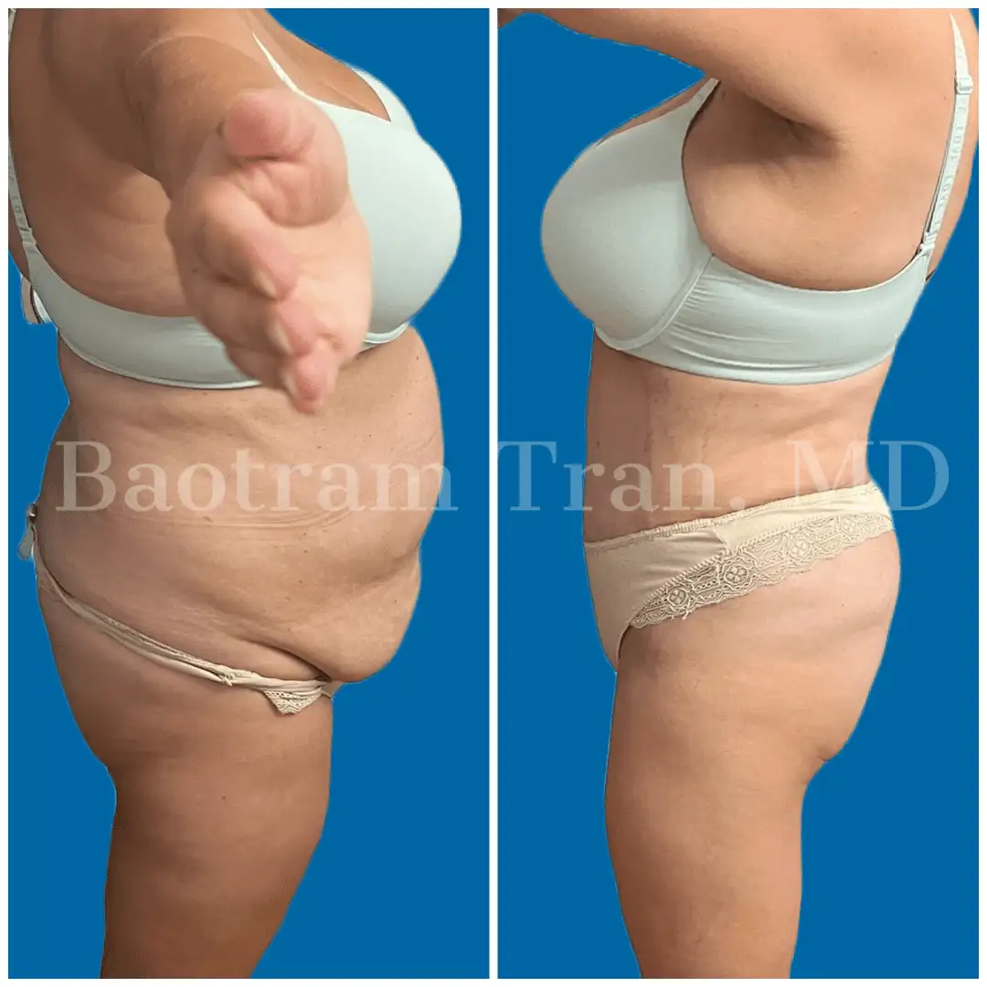 Before and After Image: Tummy Tuck - right-side
