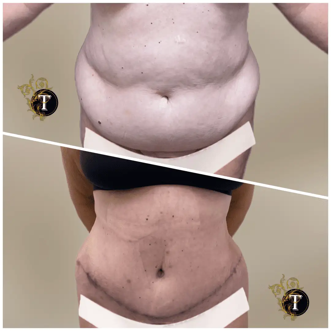 Before and After Image: Tummy Tuck - front