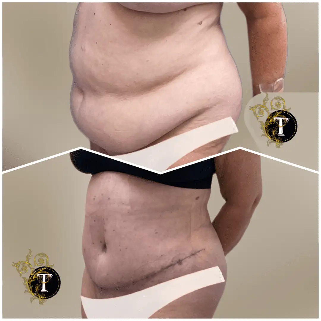 Before and After Image: Tummy Tuck - left-front-oblique
