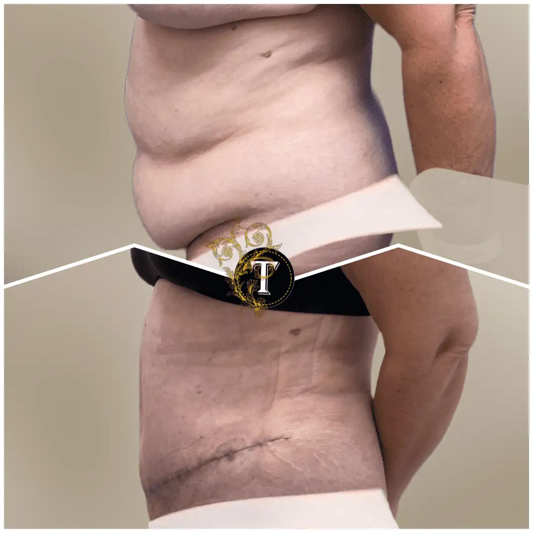 Before and After Image: Tummy Tuck - left-side