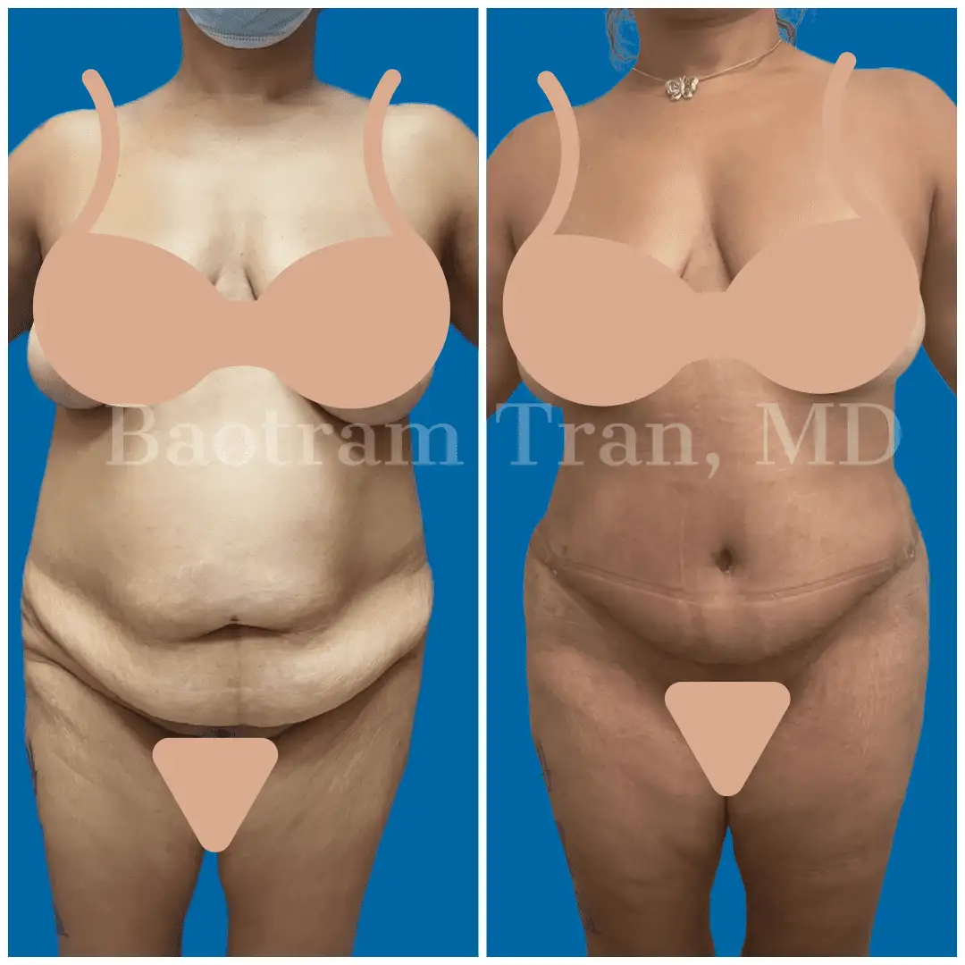 Before and After Image: Tummy Tuck - front