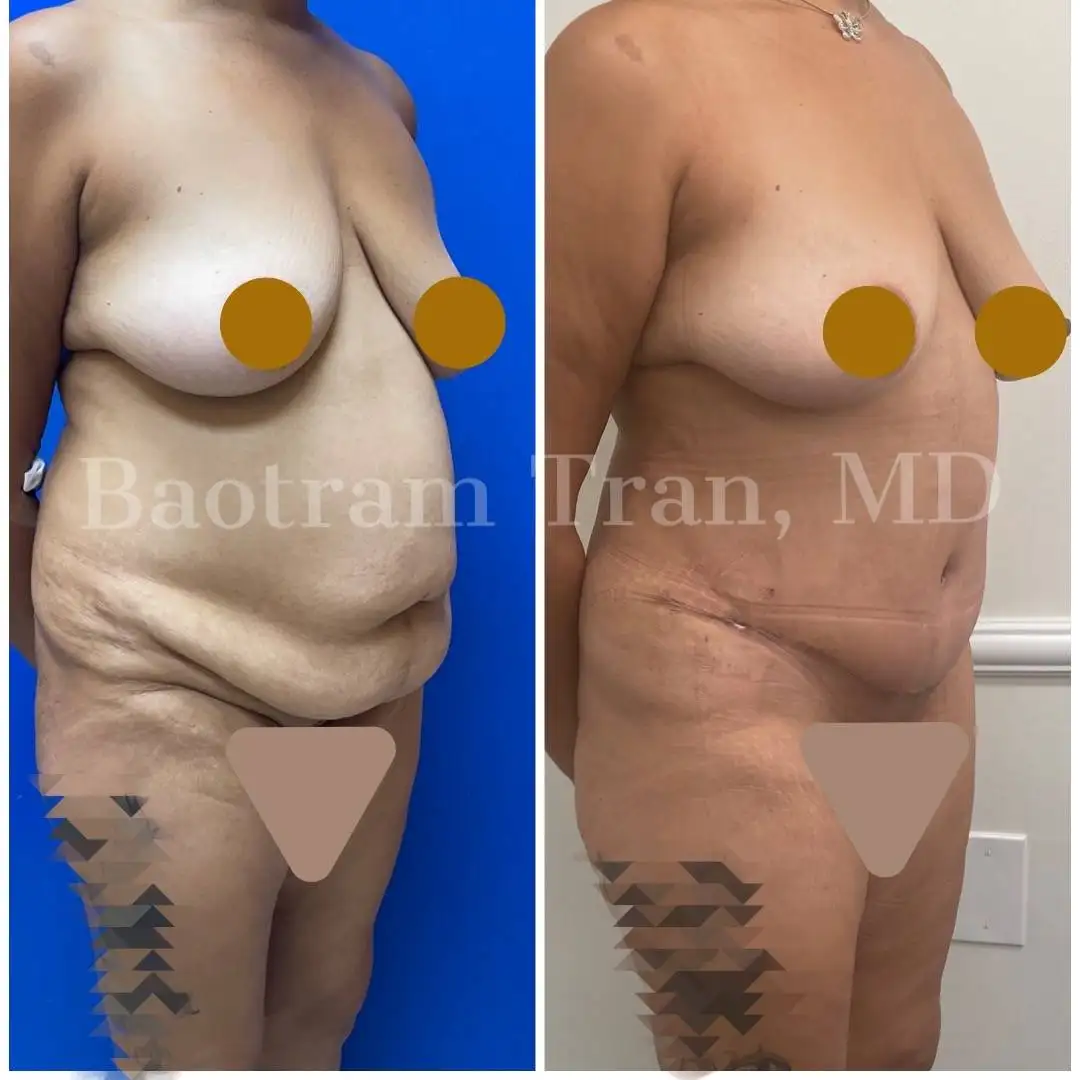 Before and After Image: Tummy Tuck - right-front-oblique