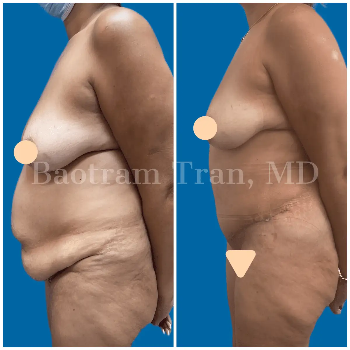 Before and After Image: Tummy Tuck - left-side