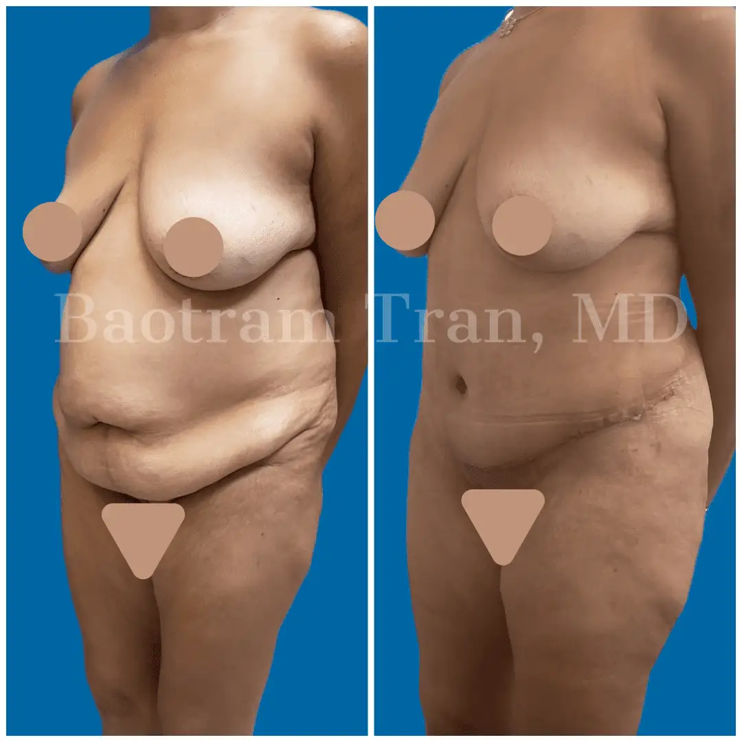 Before and After Image: Tummy Tuck - left-front-oblique