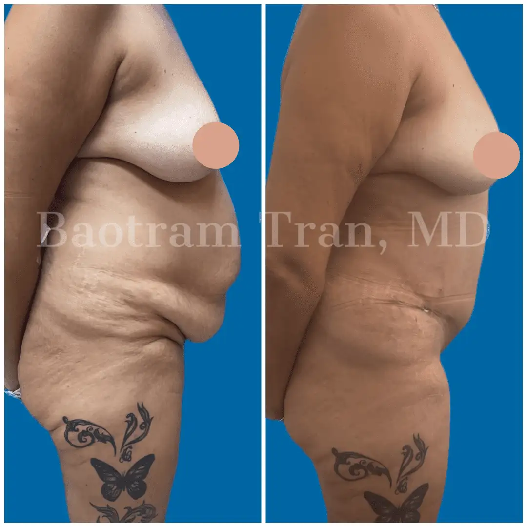 Before and After Image: Tummy Tuck - right-side