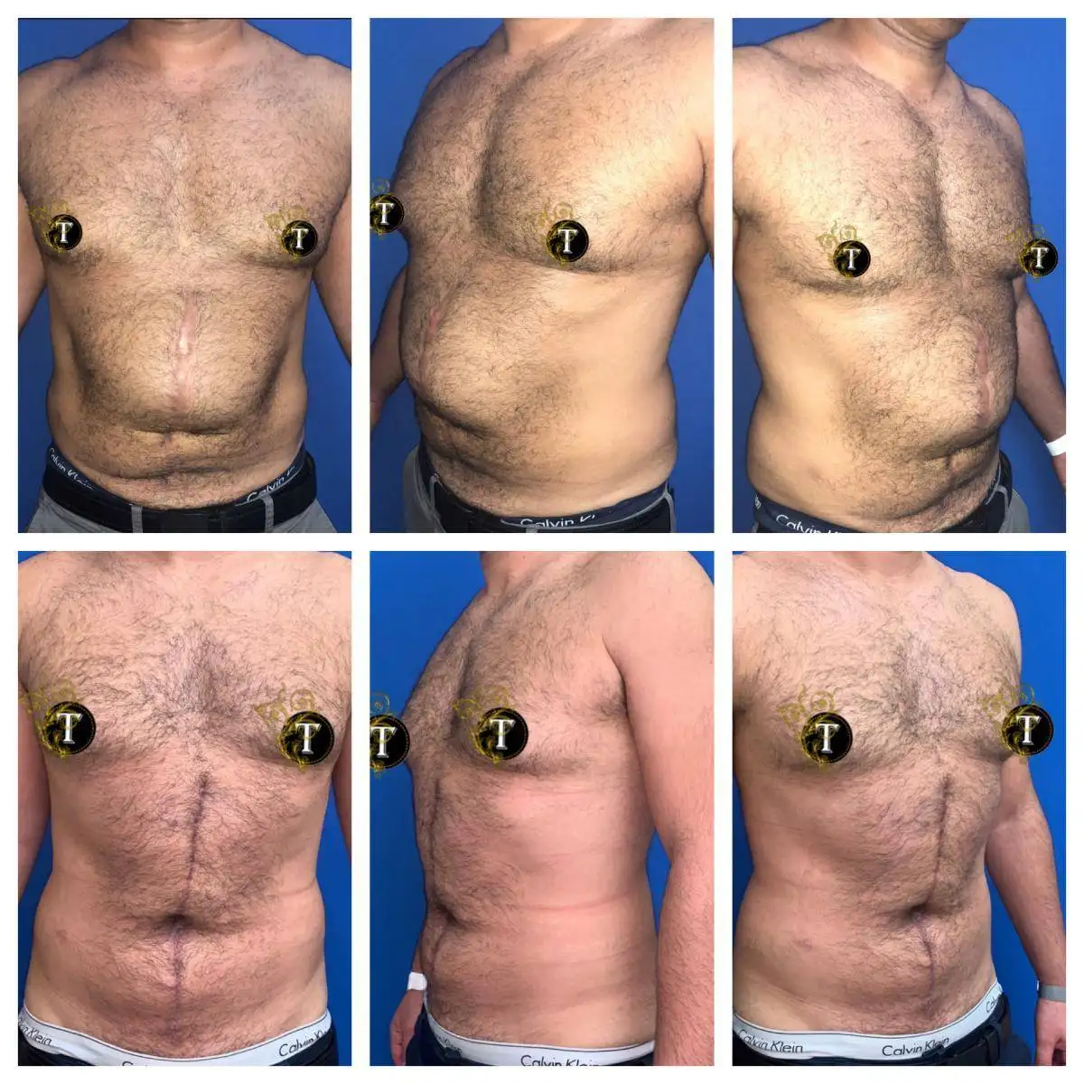Before and After Image: Tummy Tuck - front
