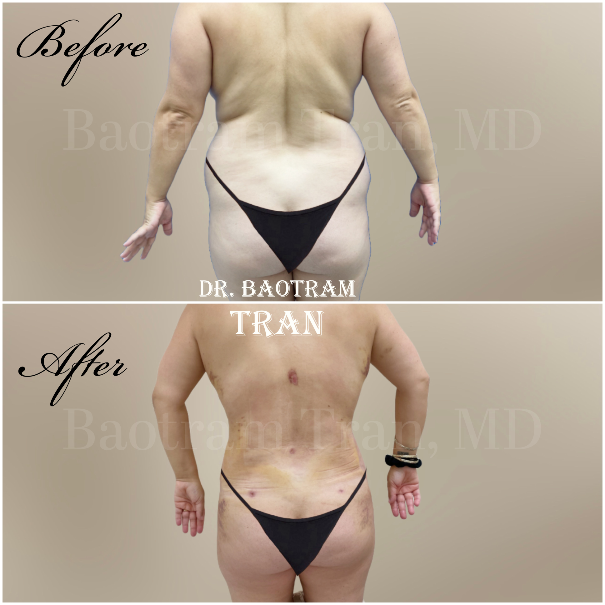 Before and After Image: Liposuction 360 - back