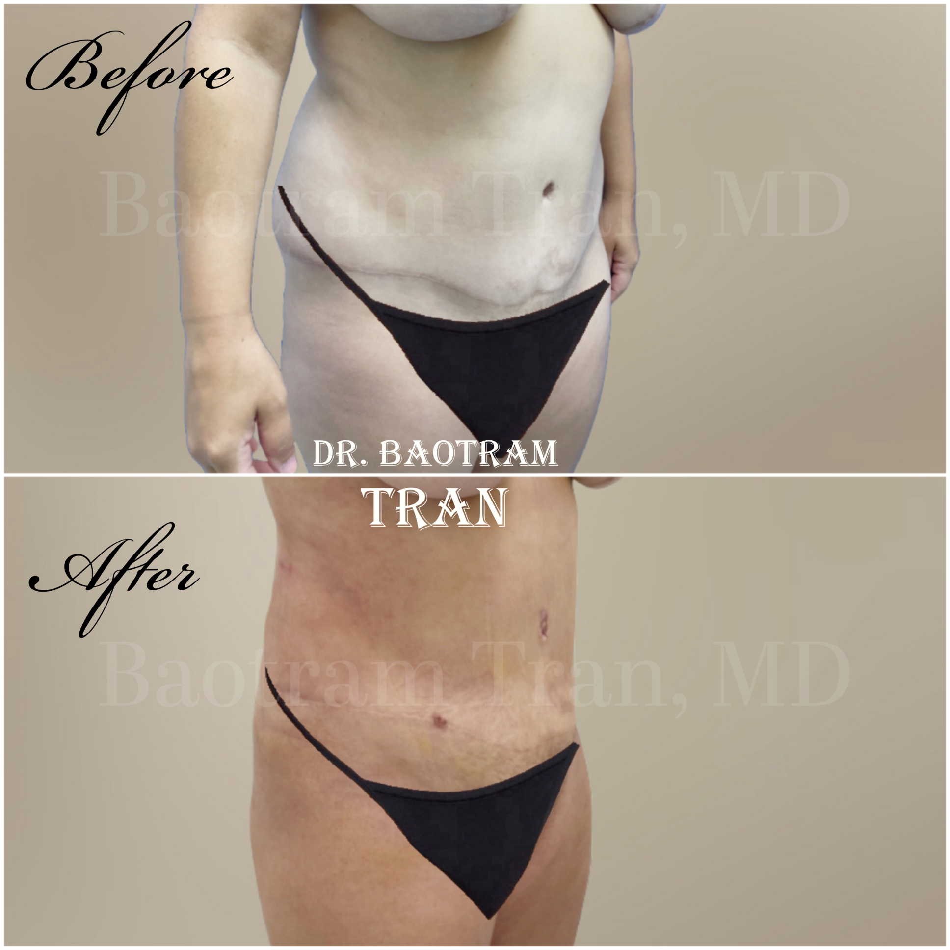 Before and After Image: Liposuction 360 - right-front-oblique