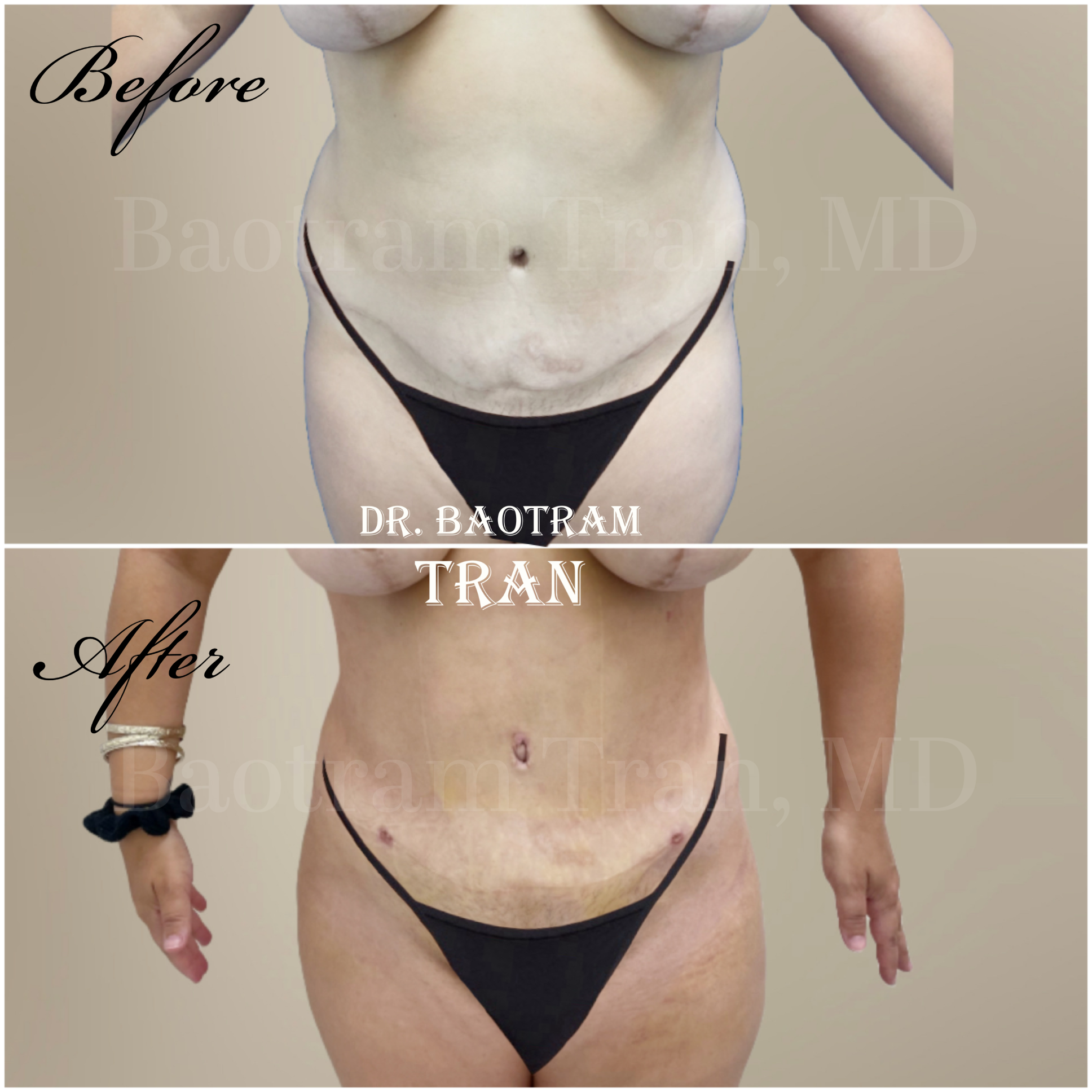 Before and After Image: Liposuction 360