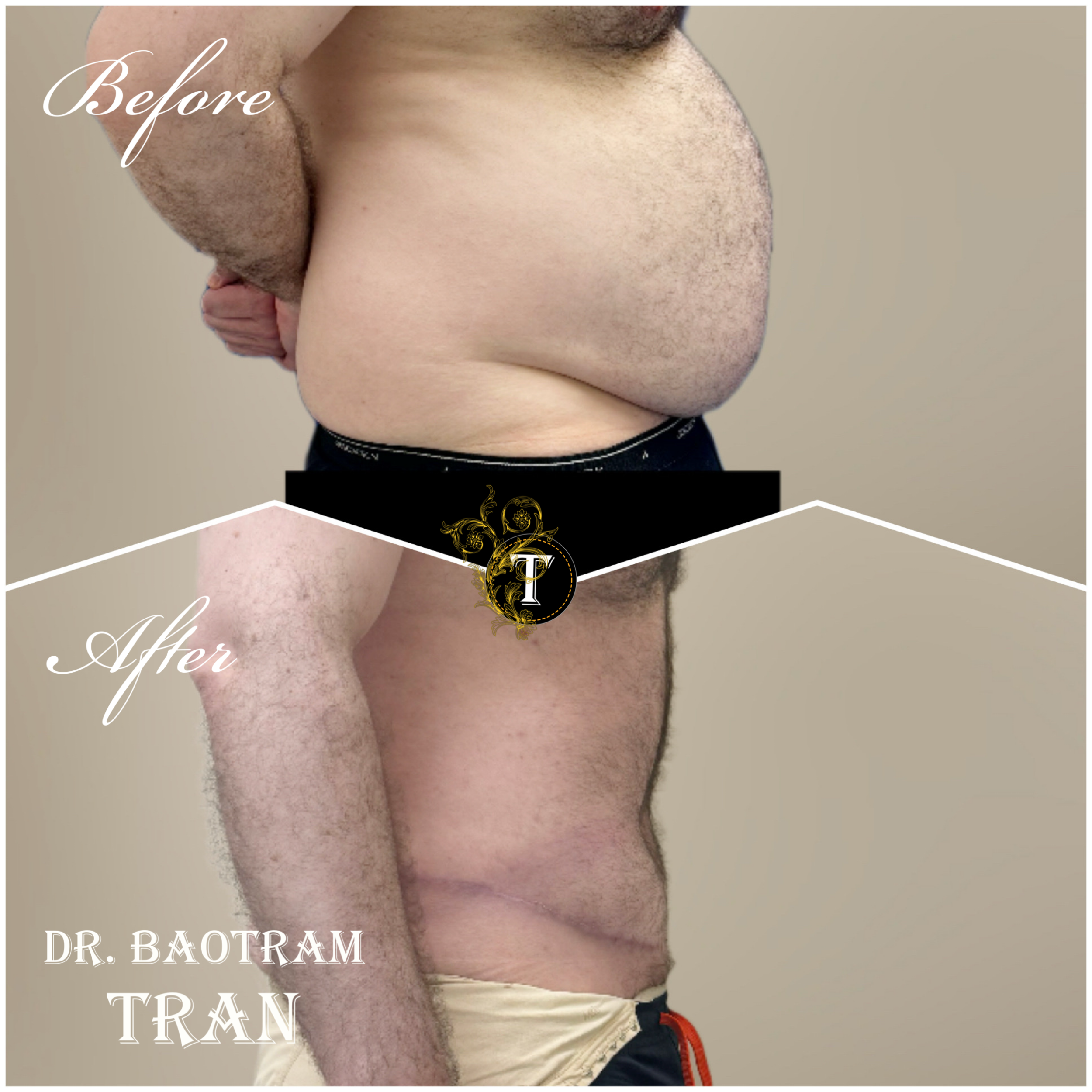 Before and After Image: Male Tummy Tuck - right-side