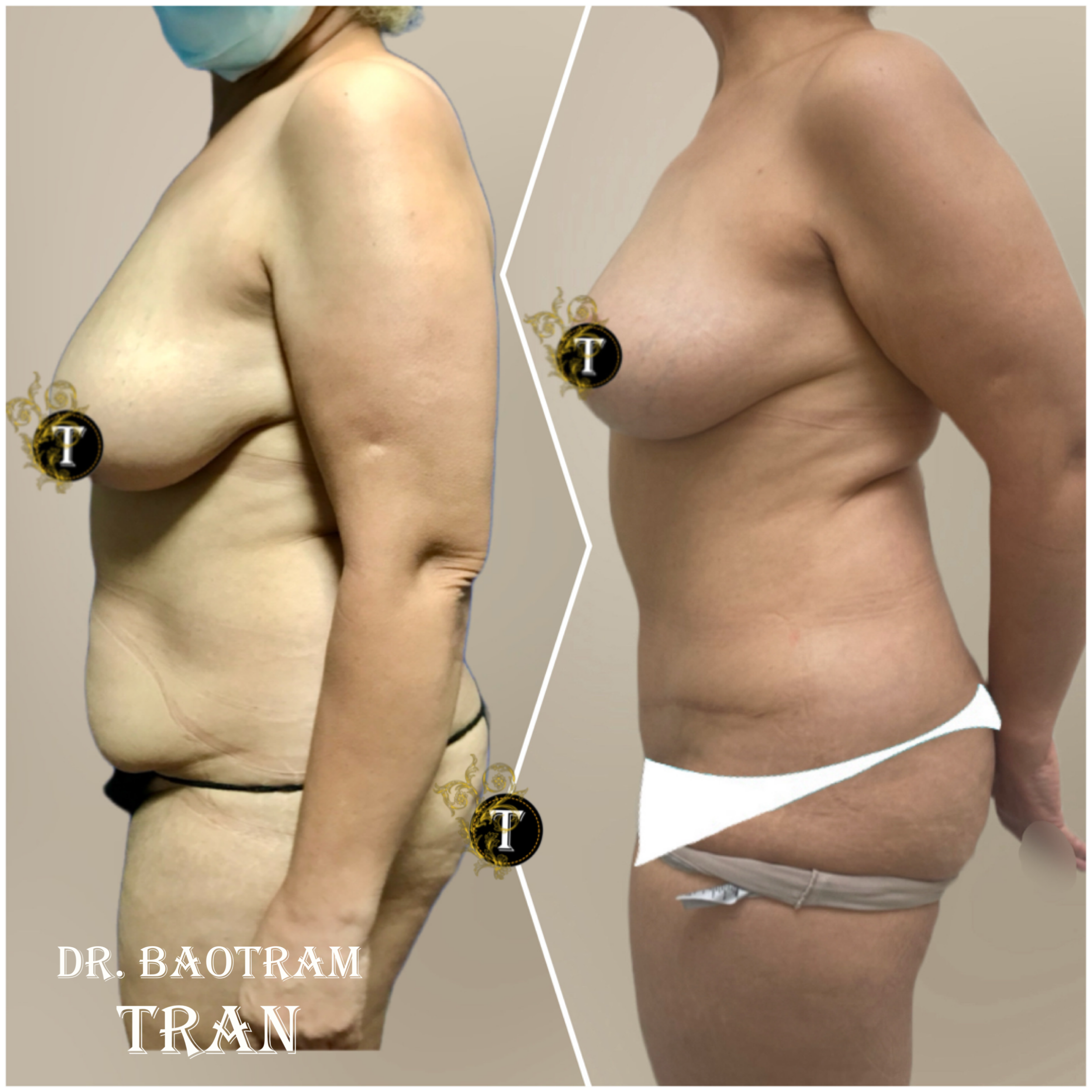 Before and After Image: Mommy Makeover - right-side