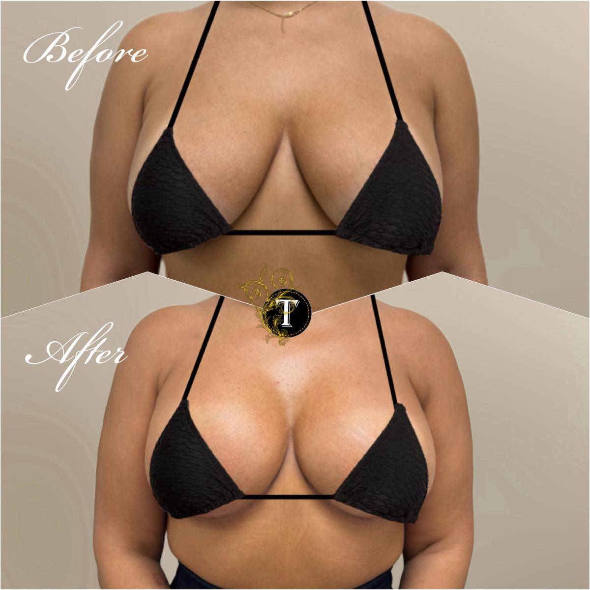Before and After Image: Breast revision - right-front-oblique