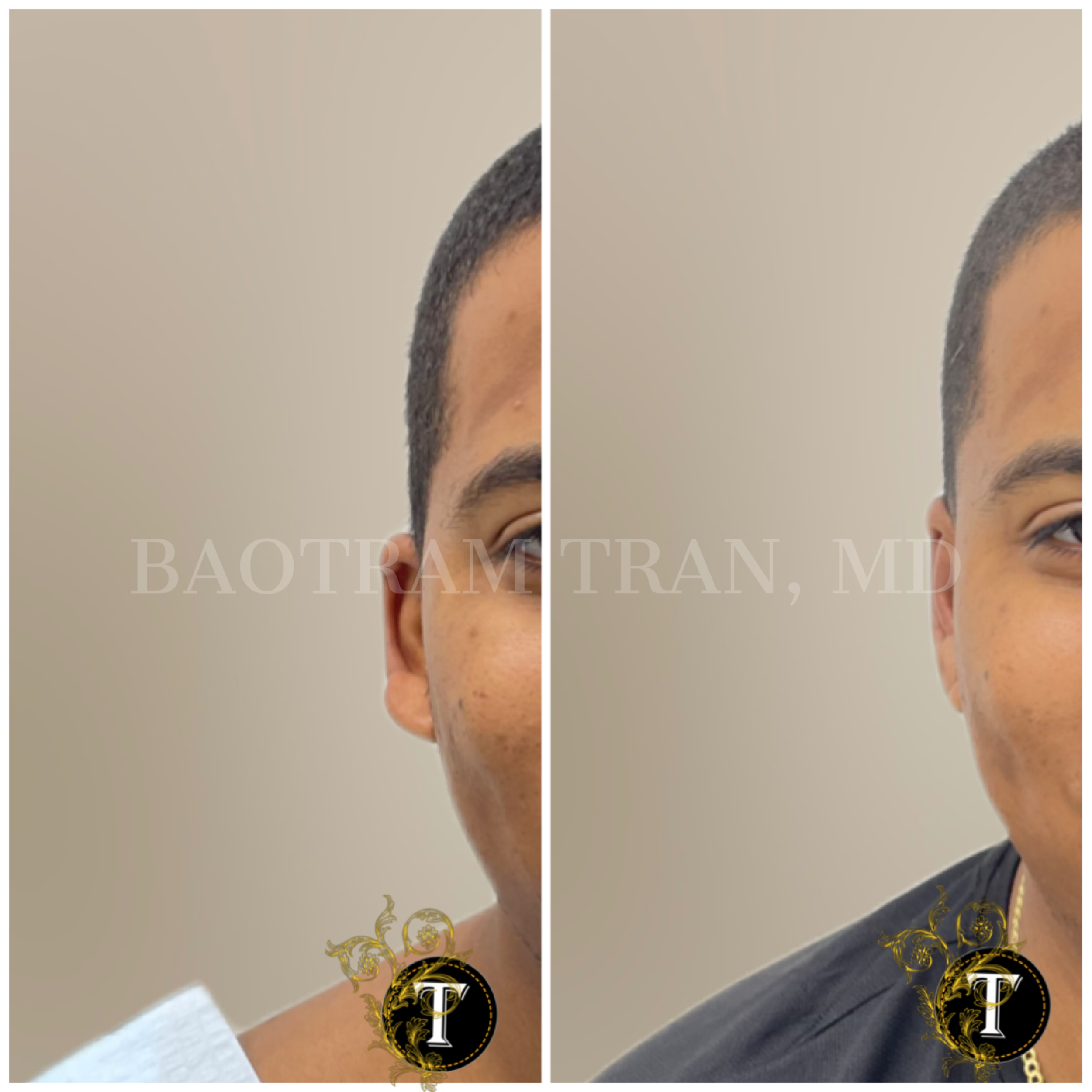 Before and After Image: Otoplasty (Ear pinning) - front