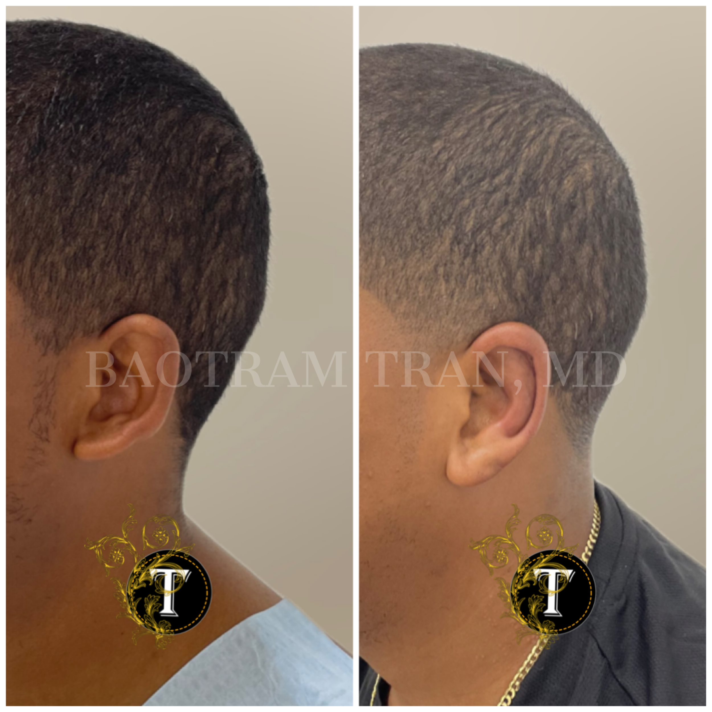 Before and After Image: Otoplasty (Ear pinning) - left-side