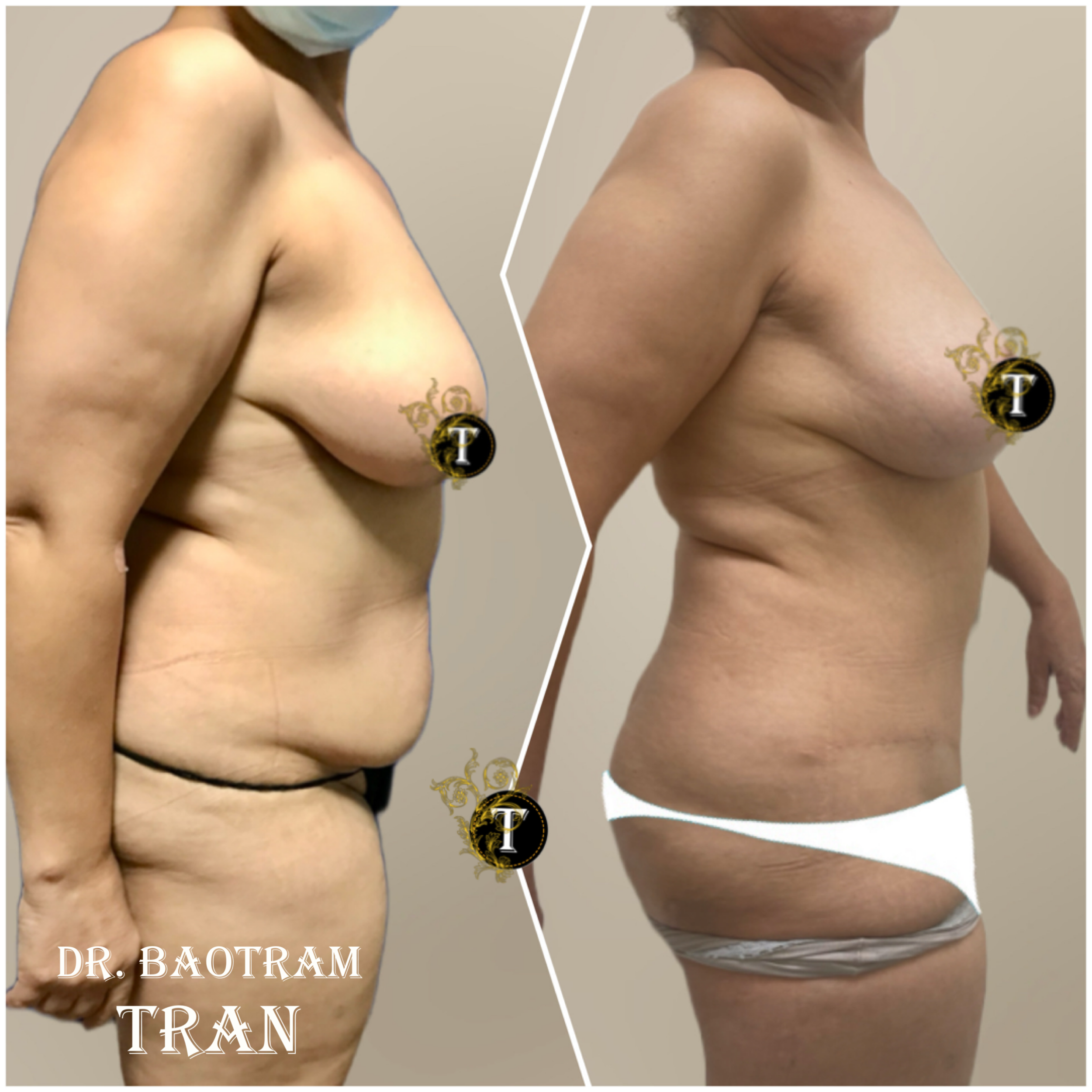 Before and After Image: Mommy Makeover - left-side